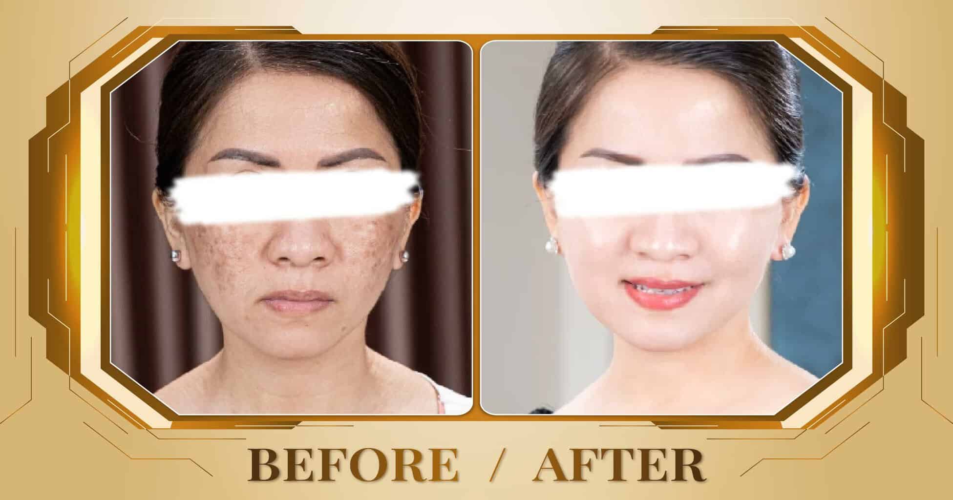 Chăm sóc da mụn hiệu quả và an toàn bằng công nghệ cao 19 Hình ảnh trước và sau khi chăm sóc da mụn tại Thẩm Mỹ Viện Beryl