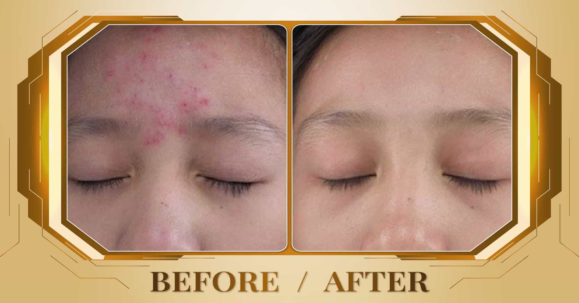 Chăm sóc da mụn hiệu quả và an toàn bằng công nghệ cao 18 Hình ảnh trước và sau khi chăm sóc da mụn tại Thẩm Mỹ Viện Beryl
