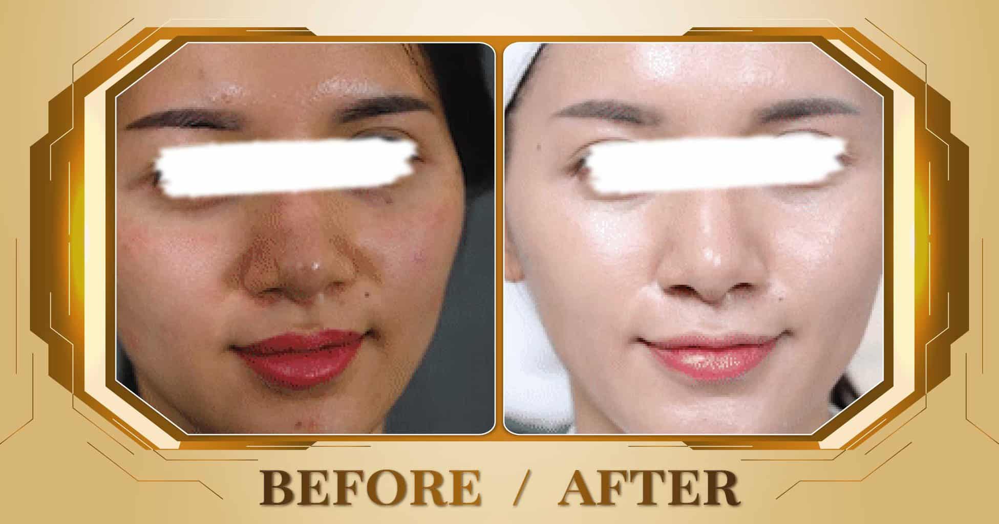 Chăm sóc da mụn hiệu quả và an toàn bằng công nghệ cao 17 Hình ảnh trước và sau khi chăm sóc da mụn tại Thẩm Mỹ Viện Beryl