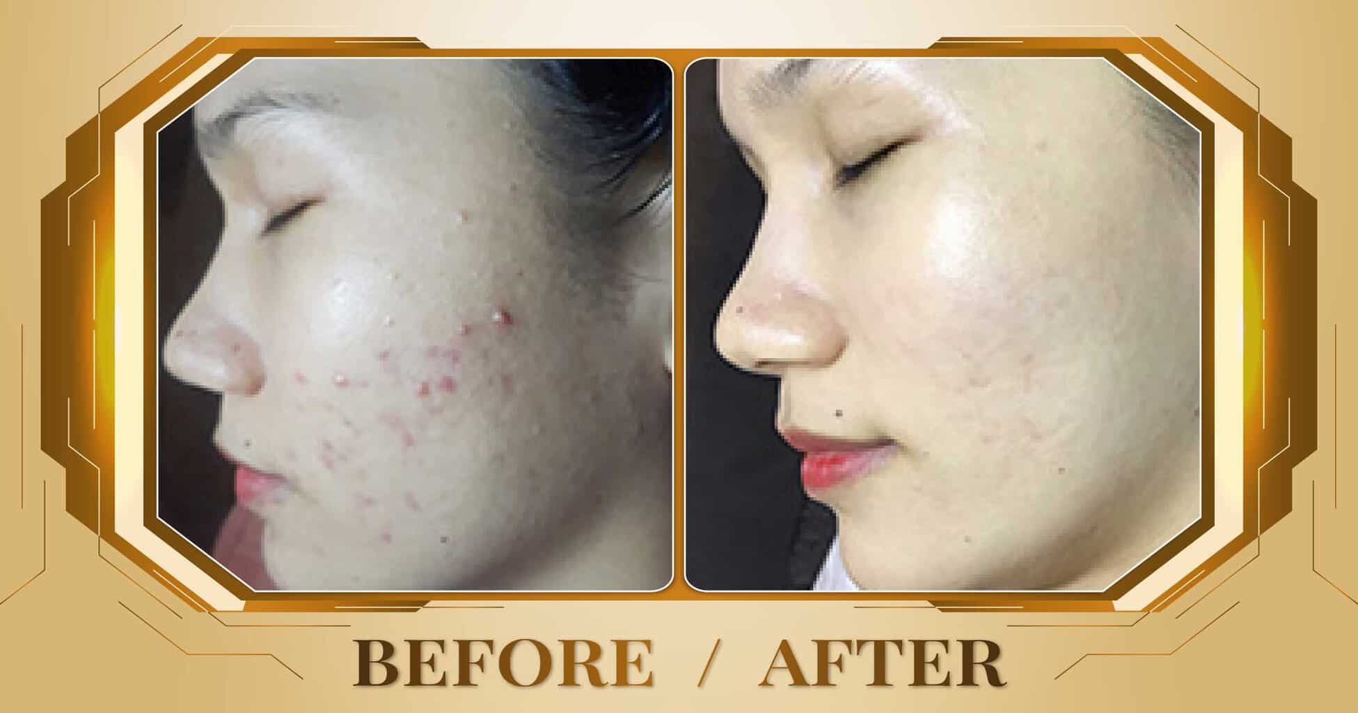 Chăm sóc da mụn hiệu quả và an toàn bằng công nghệ cao 15 Hình ảnh trước và sau khi chăm sóc da mụn tại Thẩm Mỹ Viện Beryl