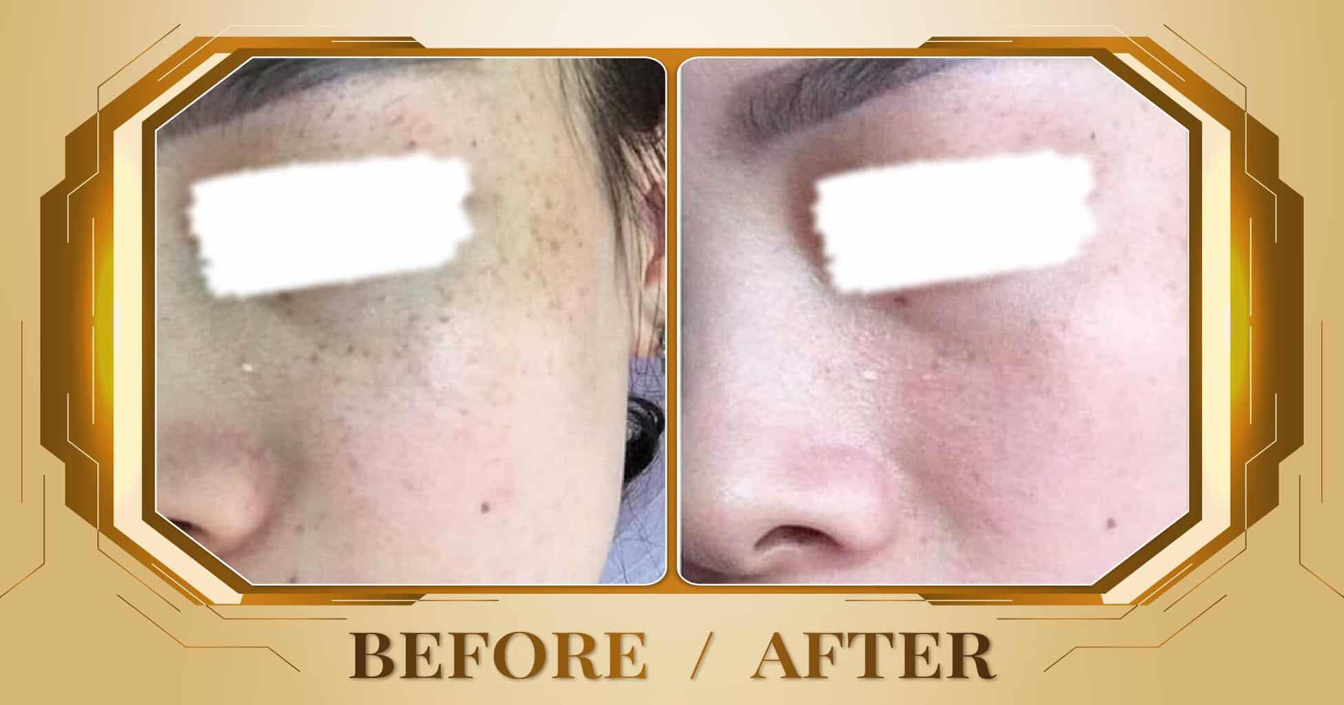 Điều trị đồi mồi bằng laser Alpha Pro+ kết hợp Magic Skin 21 Hình ảnh trước và sau khi điều trị đồi mồi trên mặt tại Thẩm Mỹ Viện Beryl