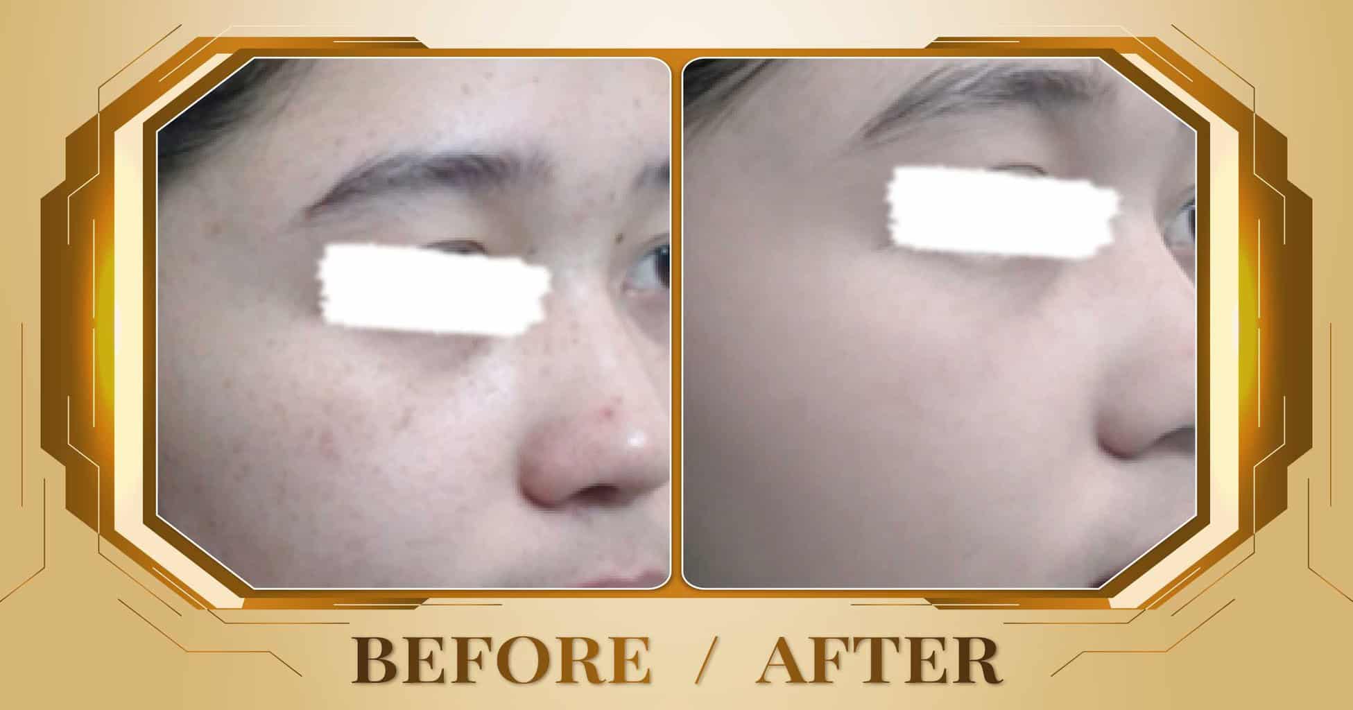 Điều trị đồi mồi bằng laser Alpha Pro+ kết hợp Magic Skin 20 Hình ảnh trước và sau khi điều trị đồi mồi trên mặt tại Thẩm Mỹ Viện Beryl
