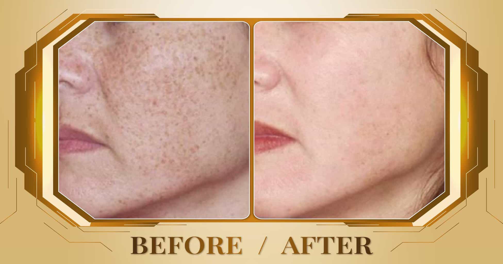 Điều trị đồi mồi bằng laser Alpha Pro+ kết hợp Magic Skin 19 Hình ảnh trước và sau khi điều trị đồi mồi trên mặt tại Thẩm Mỹ Viện Beryl
