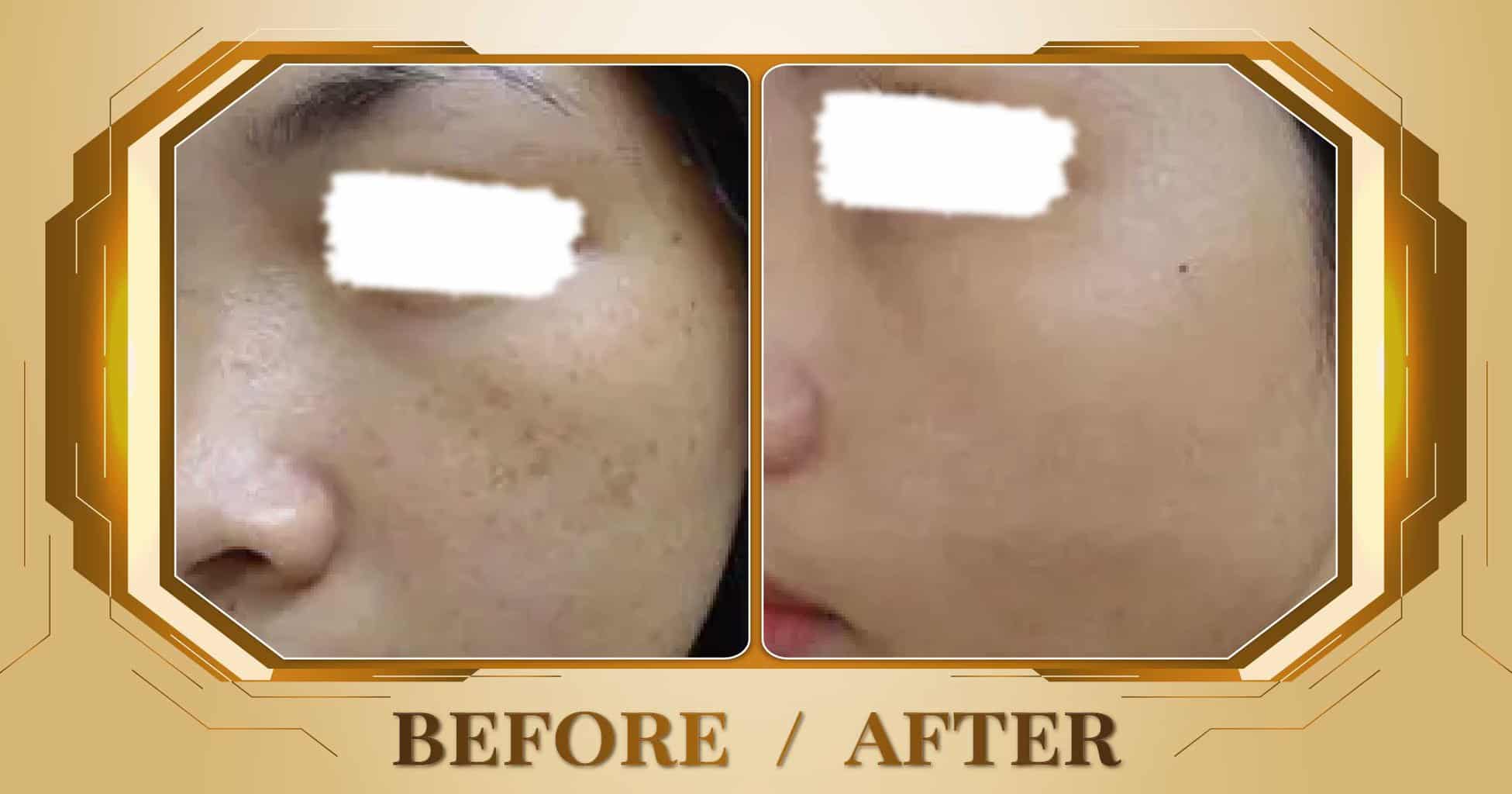 Điều trị đồi mồi bằng laser Alpha Pro+ kết hợp Magic Skin 18 Hình ảnh trước và sau khi điều trị đồi mồi trên mặt tại Thẩm Mỹ Viện Beryl