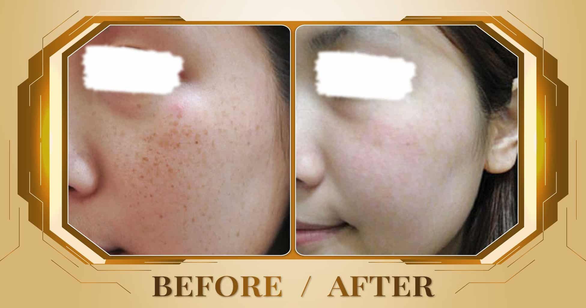 Điều trị đồi mồi bằng laser Alpha Pro+ kết hợp Magic Skin 17 Hình ảnh trước và sau khi điều trị đồi mồi trên mặt tại Thẩm Mỹ Viện Beryl