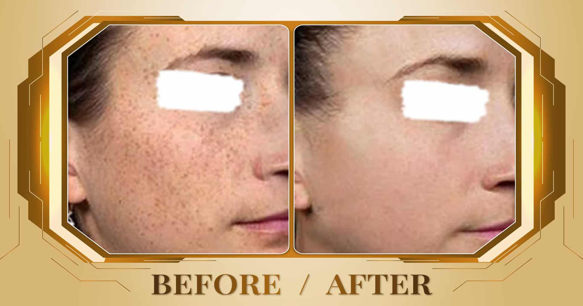 Điều trị đồi mồi bằng laser Alpha Pro+ kết hợp Magic Skin 16 Hình ảnh trước và sau khi điều trị đồi mồi trên mặt tại Thẩm Mỹ Viện Beryl