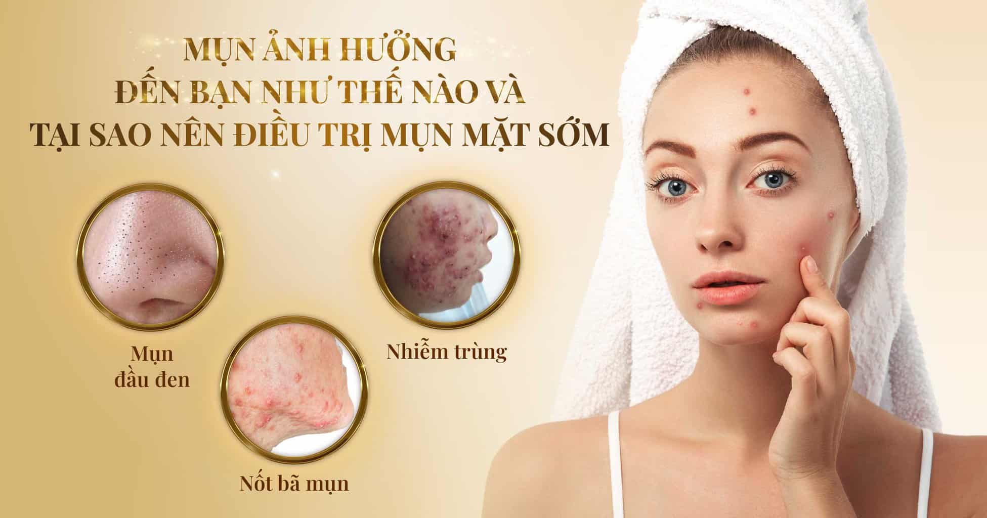 Dieu tri mun mat 01