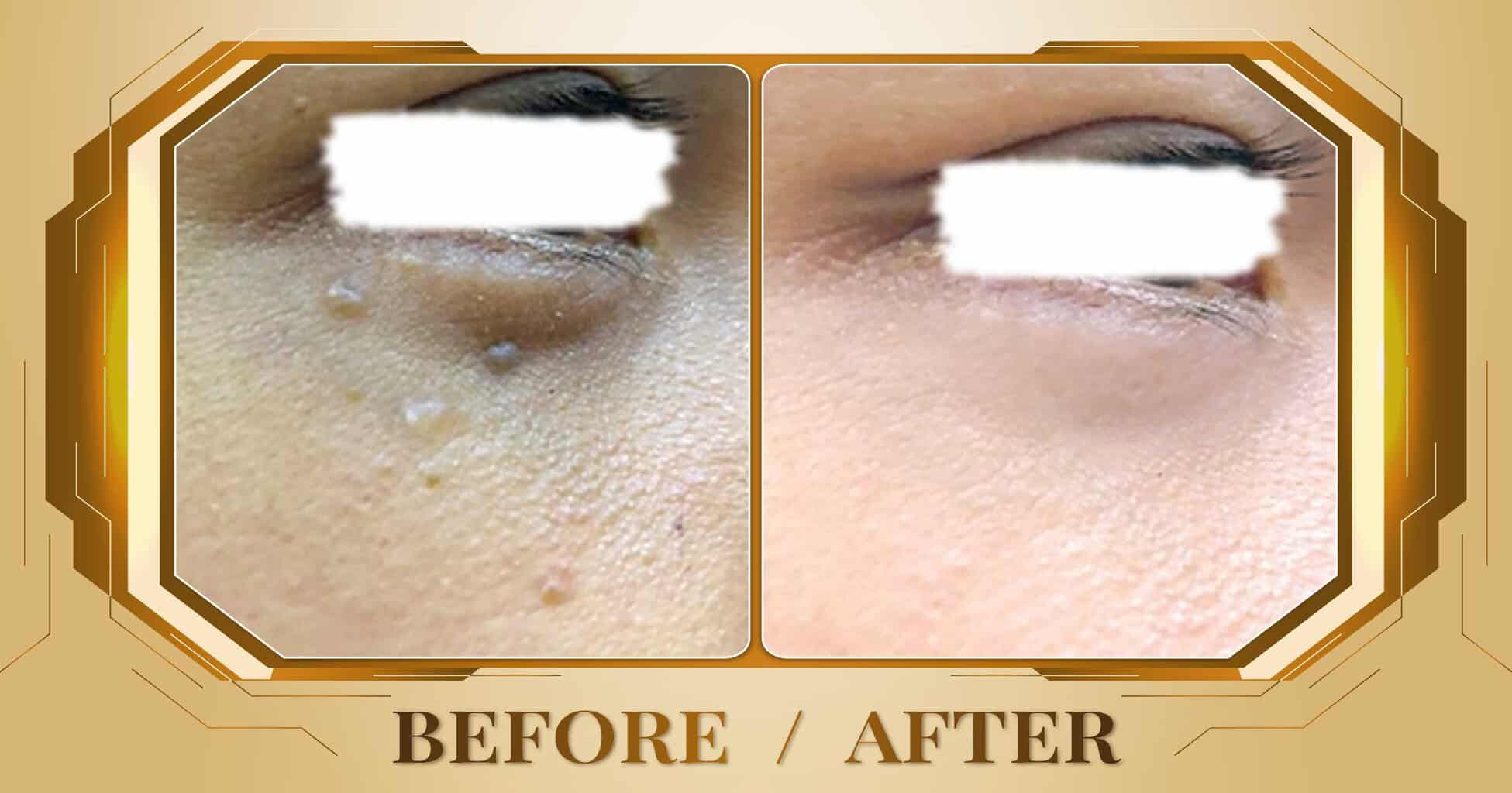 Điều trị mụn thịt bằng công nghệ laser không đau không sẹo 31 Dieu tri mun thit 03