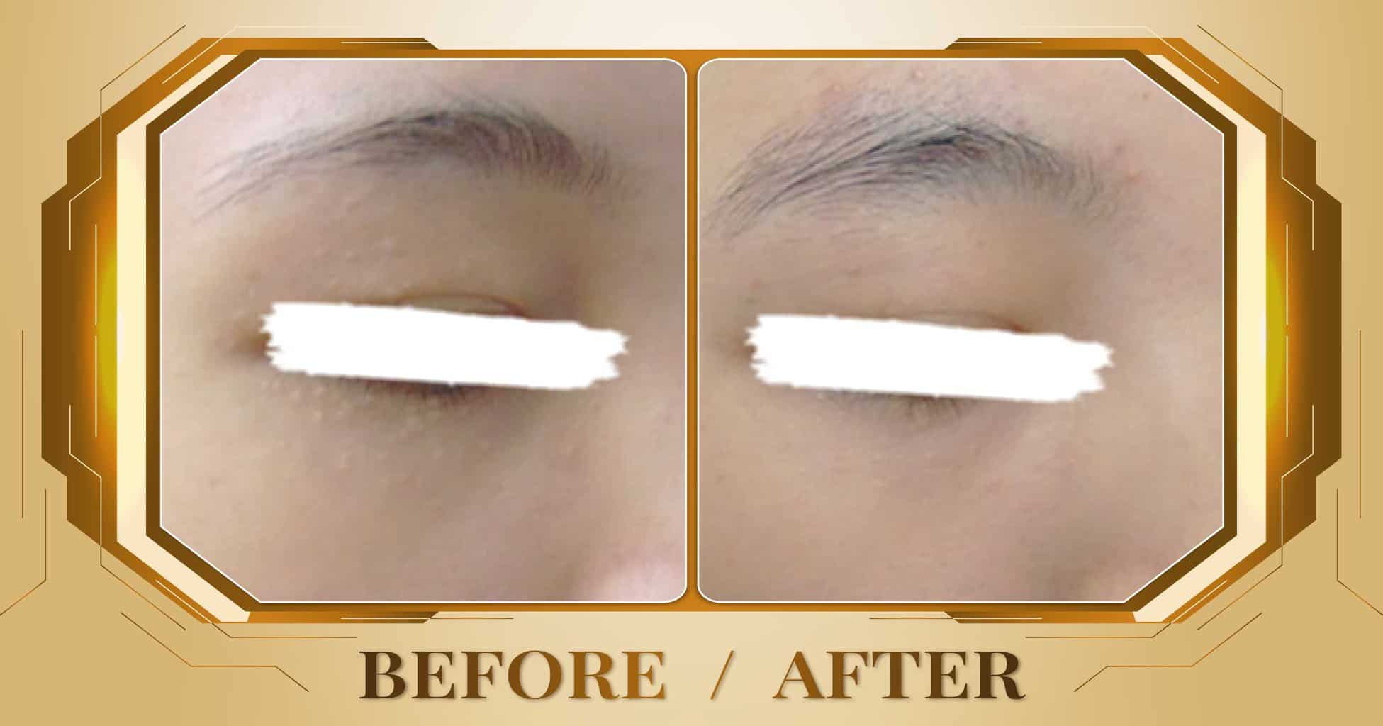 Điều trị mụn thịt bằng công nghệ laser không đau không sẹo 27 Dieu tri mun thit 05