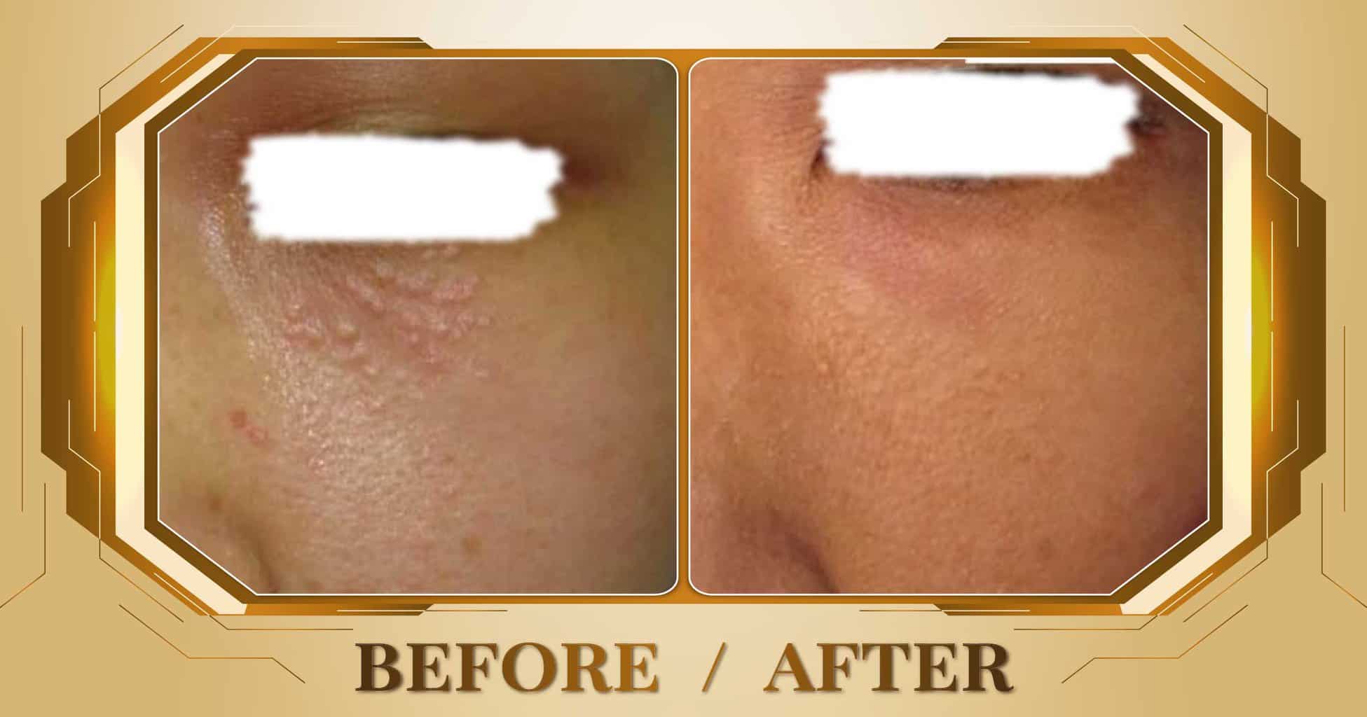 Điều trị mụn thịt bằng công nghệ laser không đau không sẹo 28 Dieu tri mun thit 06