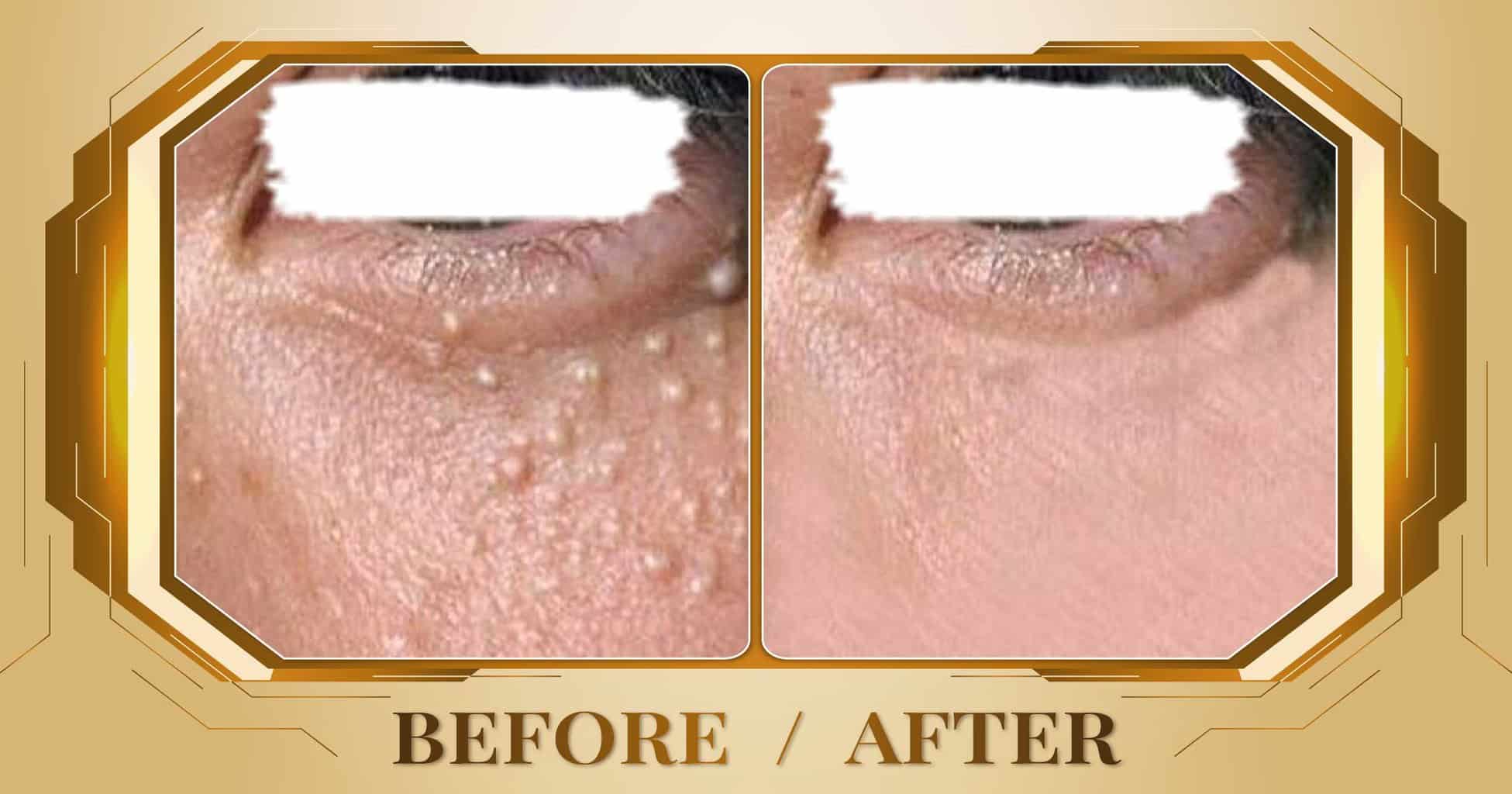 Điều trị mụn thịt bằng công nghệ laser không đau không sẹo 29 Dieu tri mun thit 07