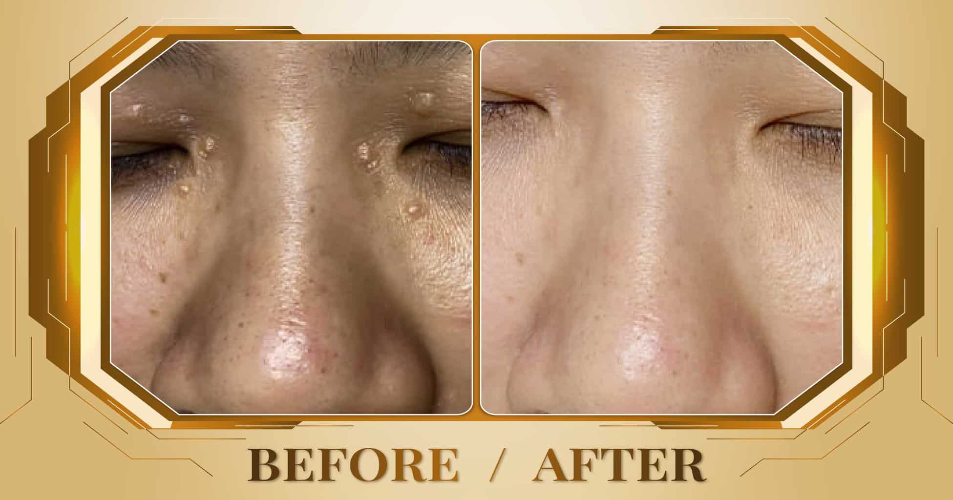 Điều trị mụn thịt bằng công nghệ laser không đau không sẹo 30 Dieu tri mun thit 08
