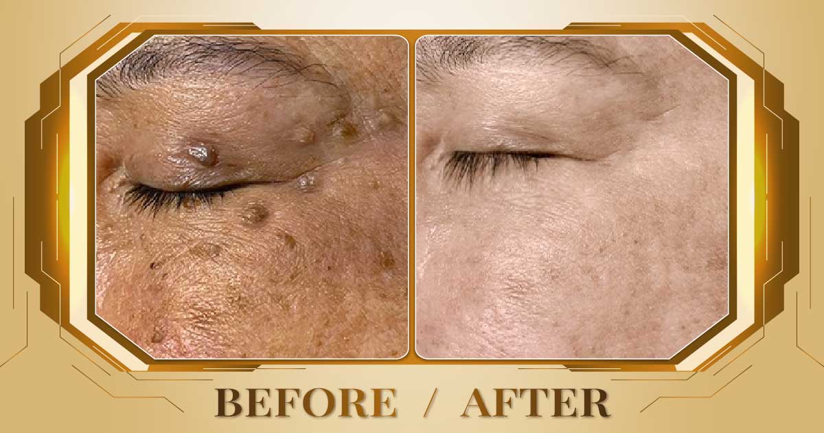 Điều trị mụn thịt bằng công nghệ laser không đau không sẹo 22 Dieu tri mun thit 09