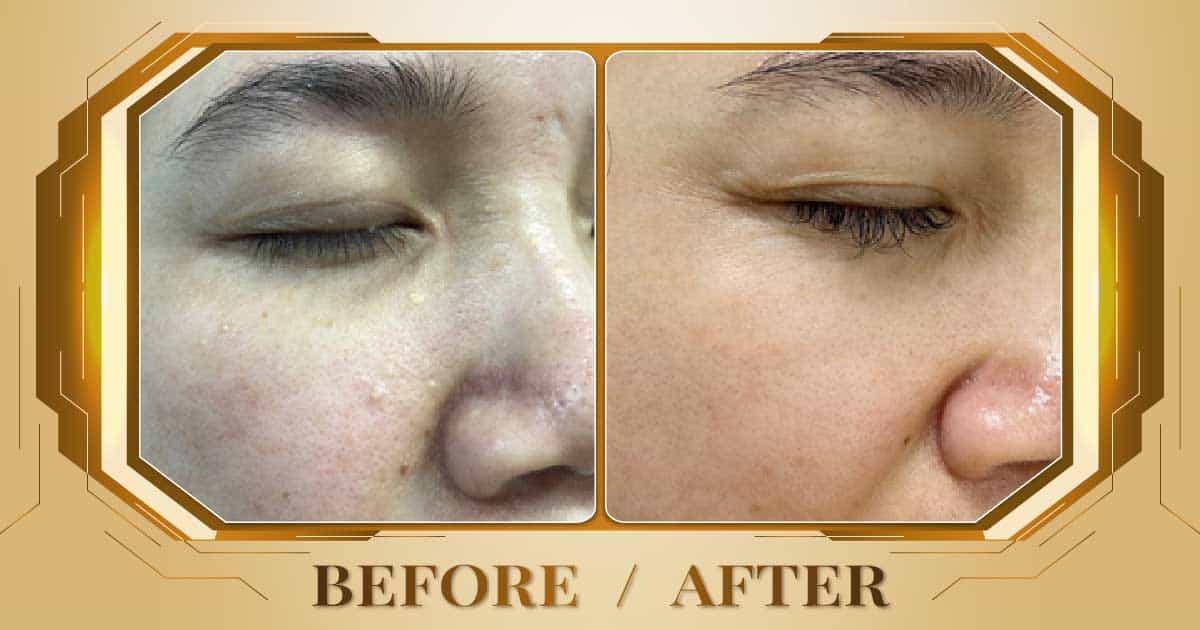 Điều trị mụn thịt bằng công nghệ laser không đau không sẹo 23 Dieu tri mun thit 10