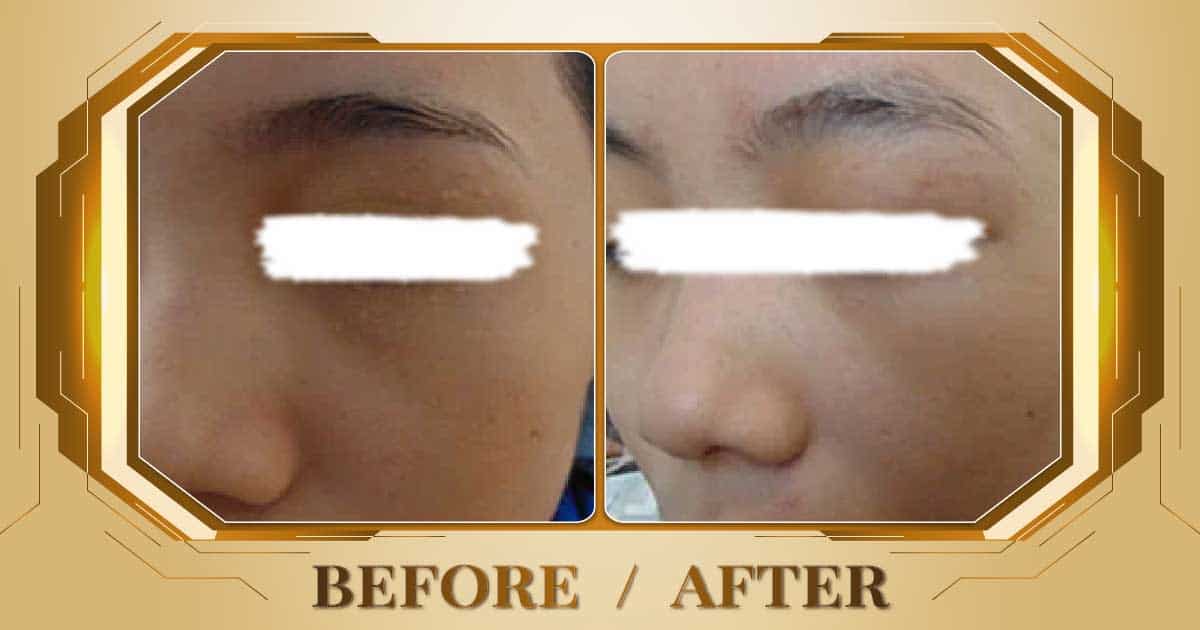 Điều trị mụn thịt bằng công nghệ laser không đau không sẹo 24 Dieu tri mun thit 11