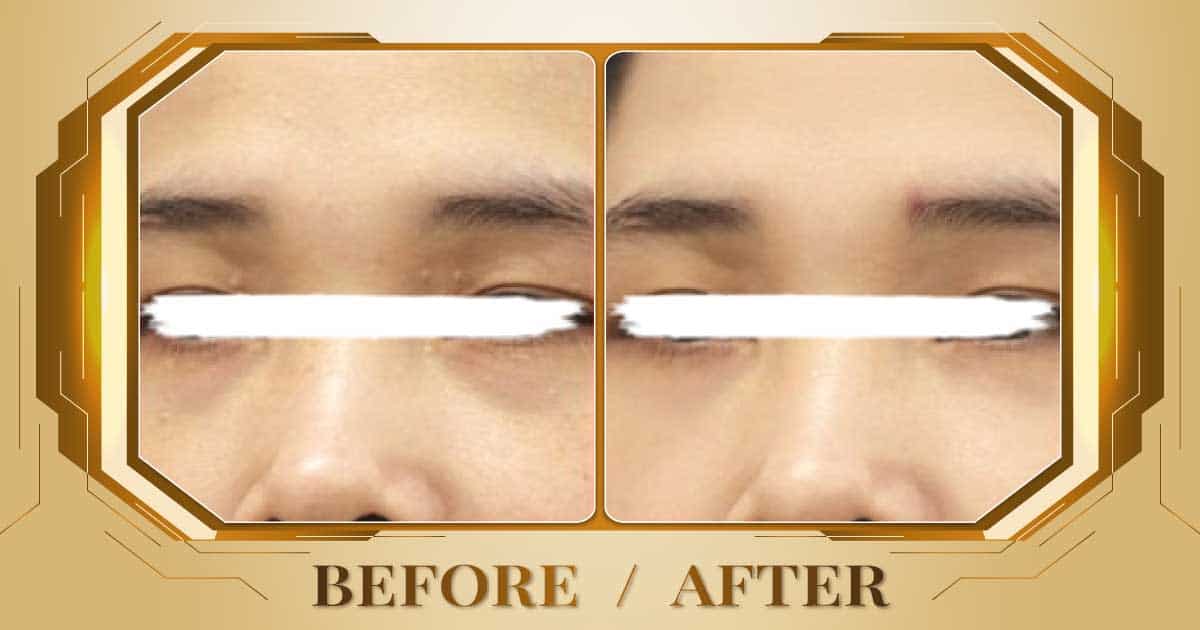 Điều trị mụn thịt bằng công nghệ laser không đau không sẹo 25 Dieu tri mun thit 12