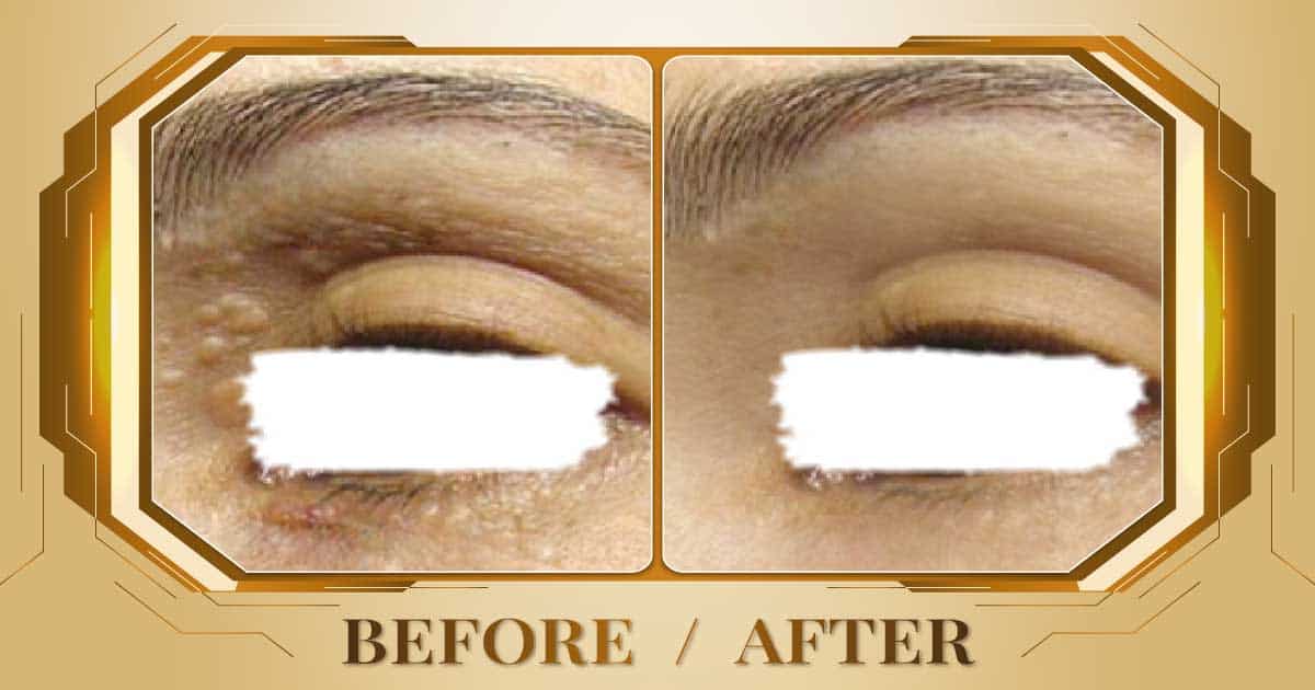 Điều trị mụn thịt bằng công nghệ laser không đau không sẹo 26 Dieu tri mun thit 13