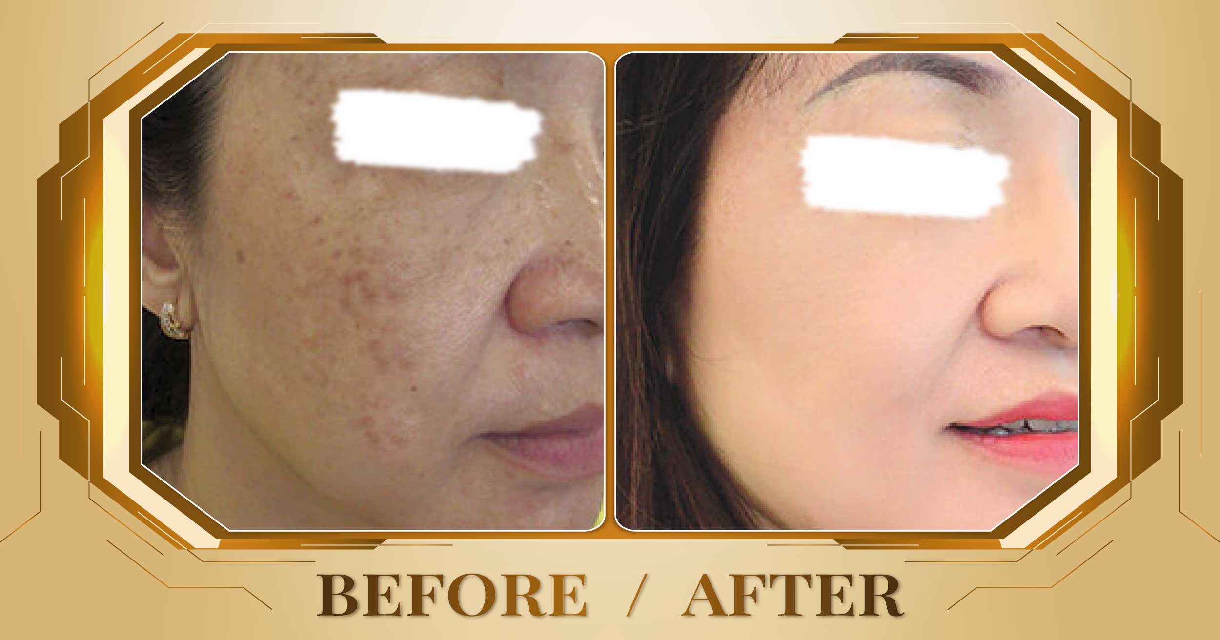 Điều trị nám mảng bằng laser Alpha Pro+ kết hợp Magic Skin 23 Dieu tri nam mang 06