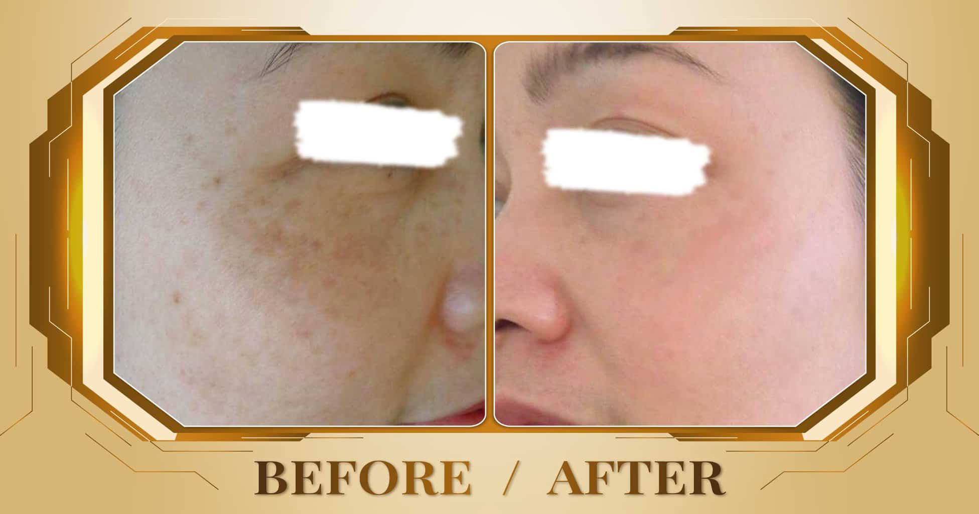 Tăng sắc tố - Điều trị tăng sắc tố da mặt bằng công nghệ cao 14 Hình ảnh trước và sau khi điều trị tăng sắc tố da mặt tại Thẩm Mỹ Viện Beryl