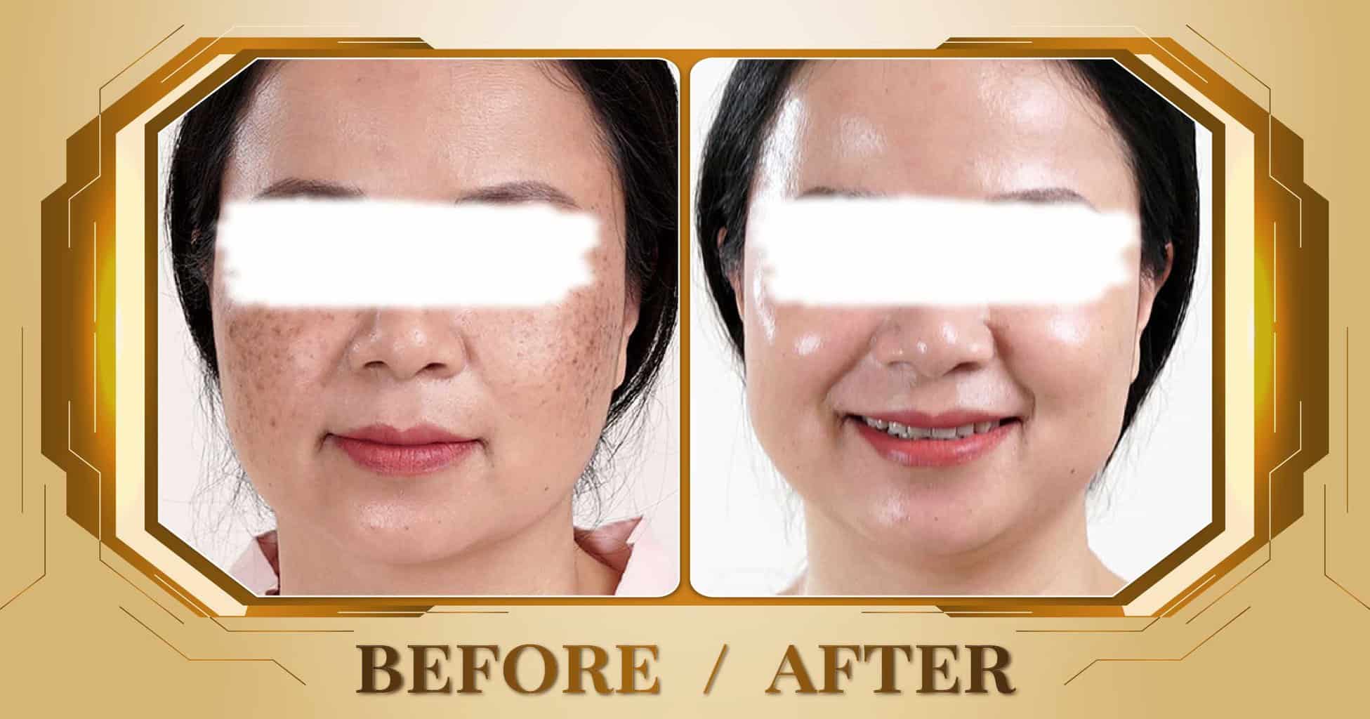 Tăng sắc tố - Điều trị tăng sắc tố da mặt bằng công nghệ cao 17 Hình ảnh trước và sau khi điều trị tăng sắc tố da mặt tại Thẩm Mỹ Viện Beryl