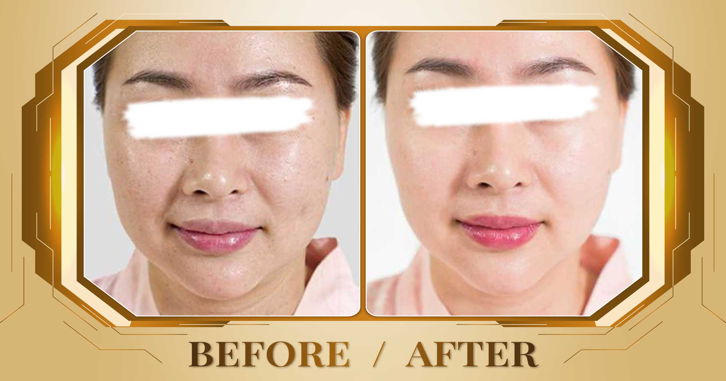 Lấy nhân mụn chuẩn y khoa tại Thẩm Mỹ Viện Beryl 20 Lay nhan mun 03