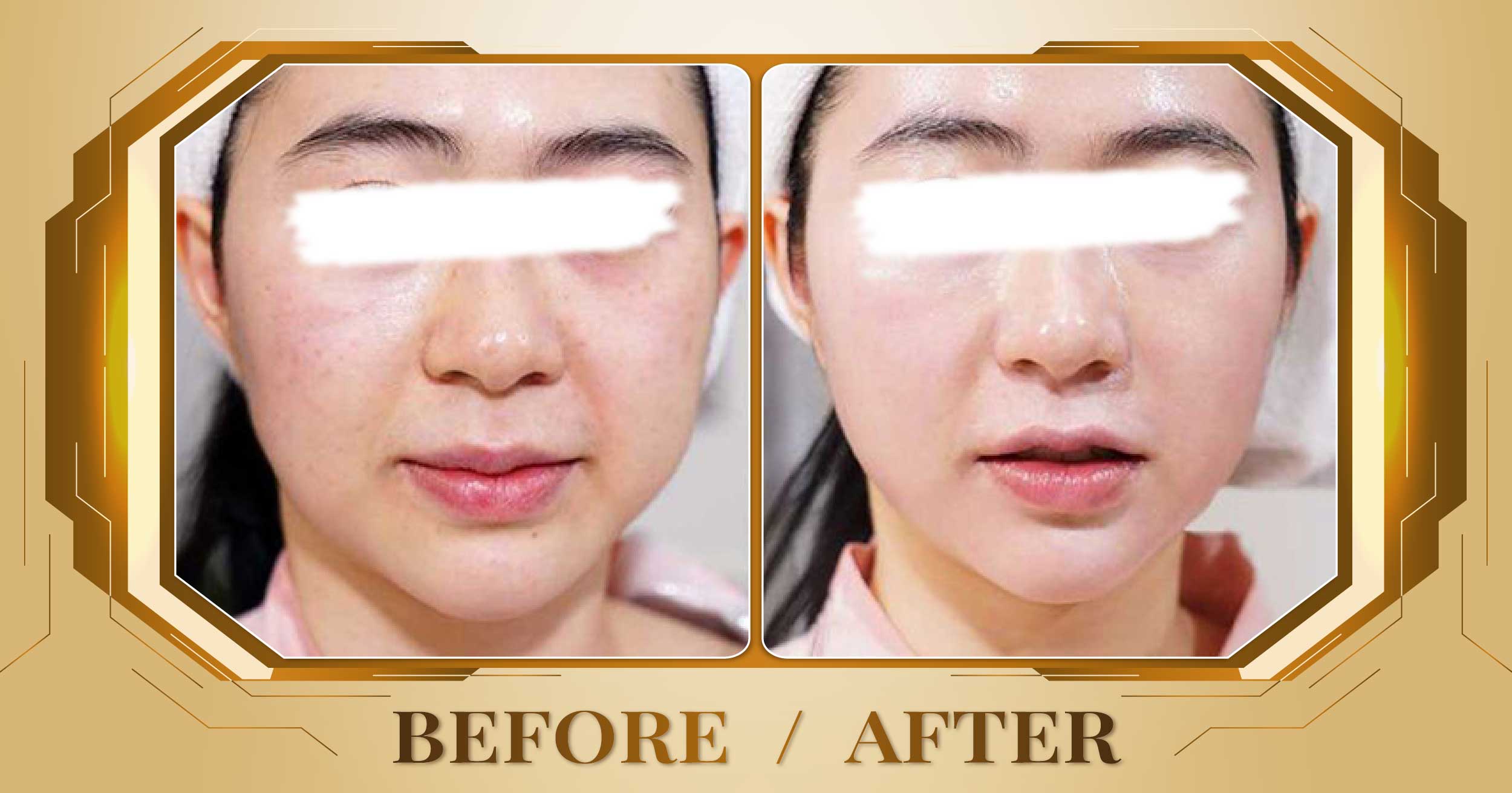 Lấy nhân mụn chuẩn y khoa tại Thẩm Mỹ Viện Beryl 21 Lay nhan mun 05