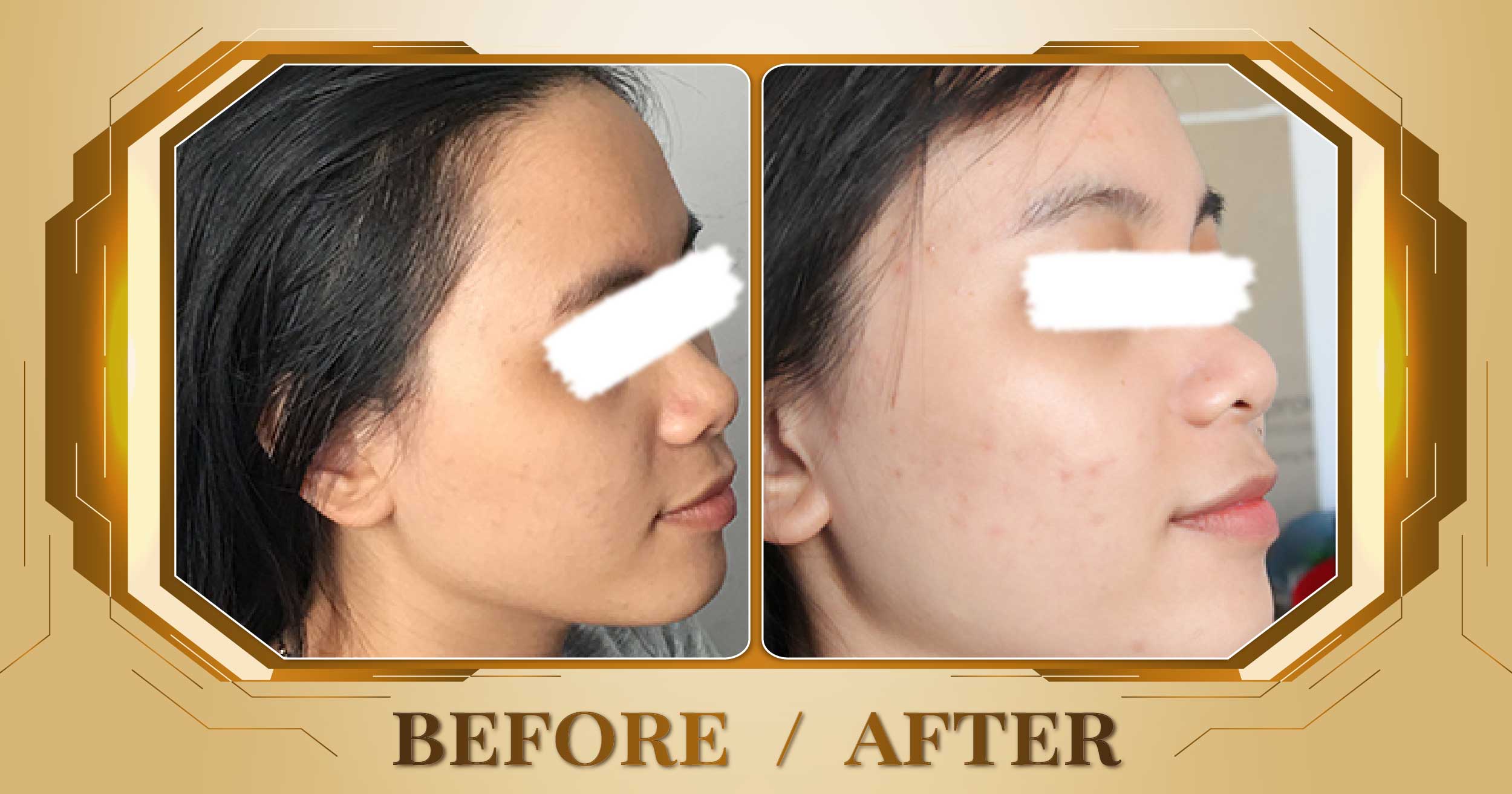Lấy nhân mụn chuẩn y khoa tại Thẩm Mỹ Viện Beryl 22 Lay nhan mun 06