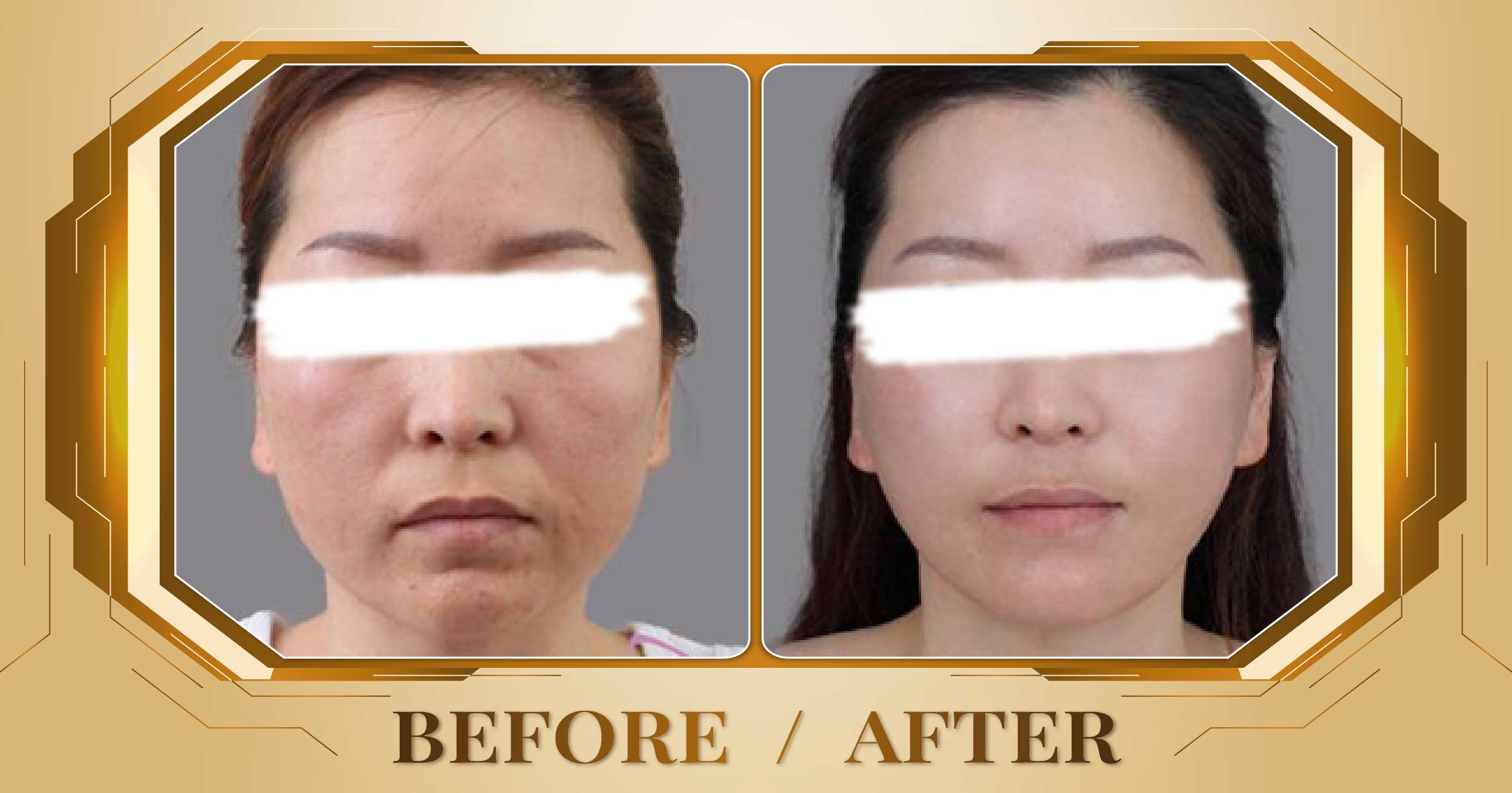 Lấy nhân mụn chuẩn y khoa tại Thẩm Mỹ Viện Beryl 23 Lay nhan mun 07