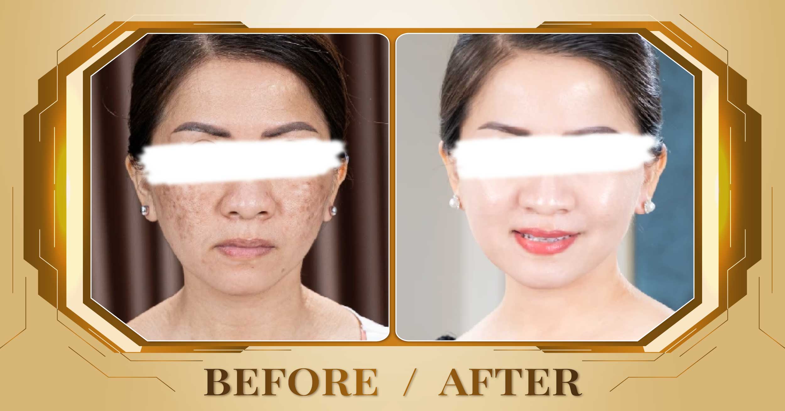Lấy nhân mụn chuẩn y khoa tại Thẩm Mỹ Viện Beryl 24 Lay nhan mun 08
