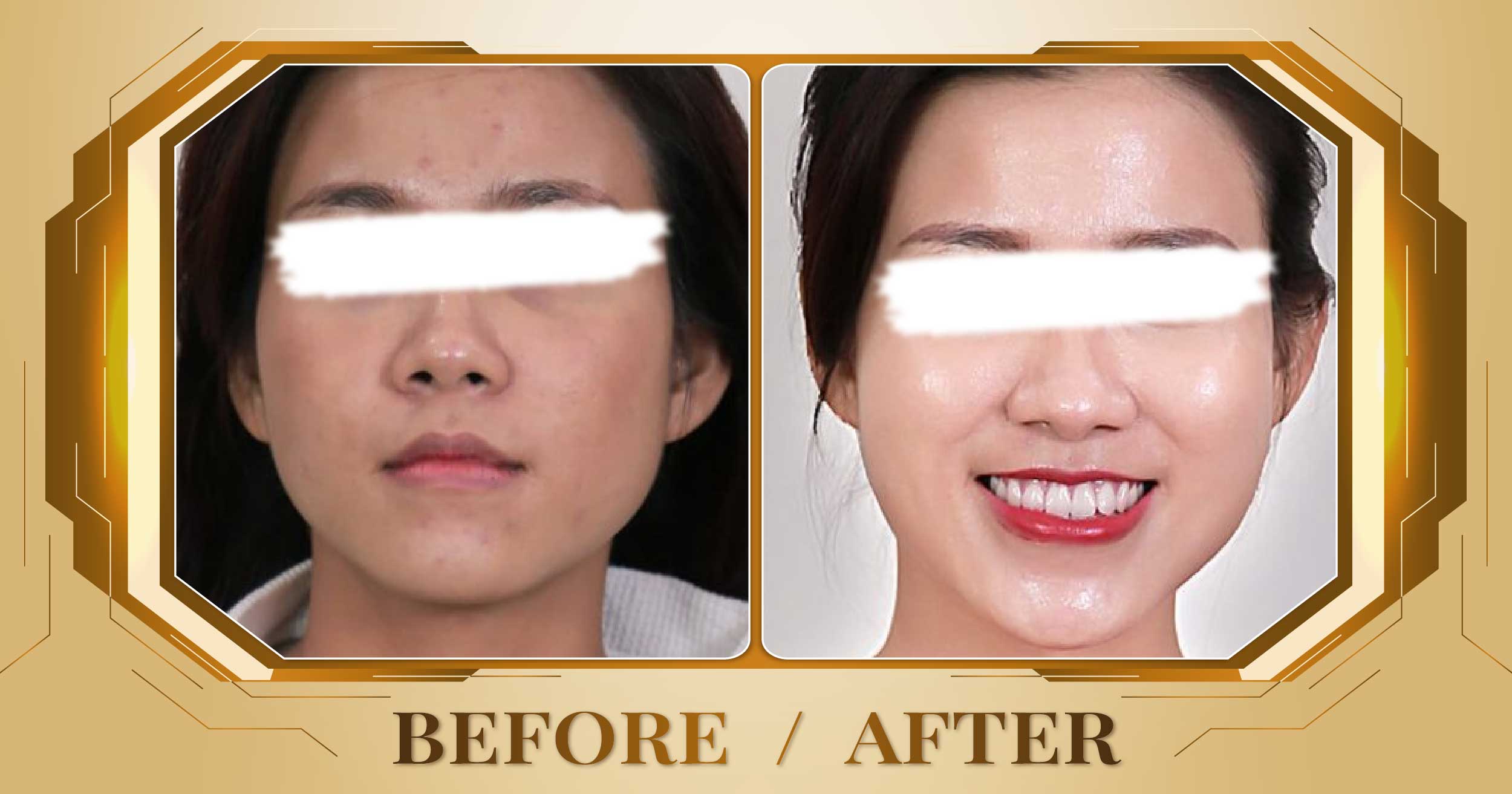 Lấy nhân mụn chuẩn y khoa tại Thẩm Mỹ Viện Beryl 26 Lay nhan mun 10