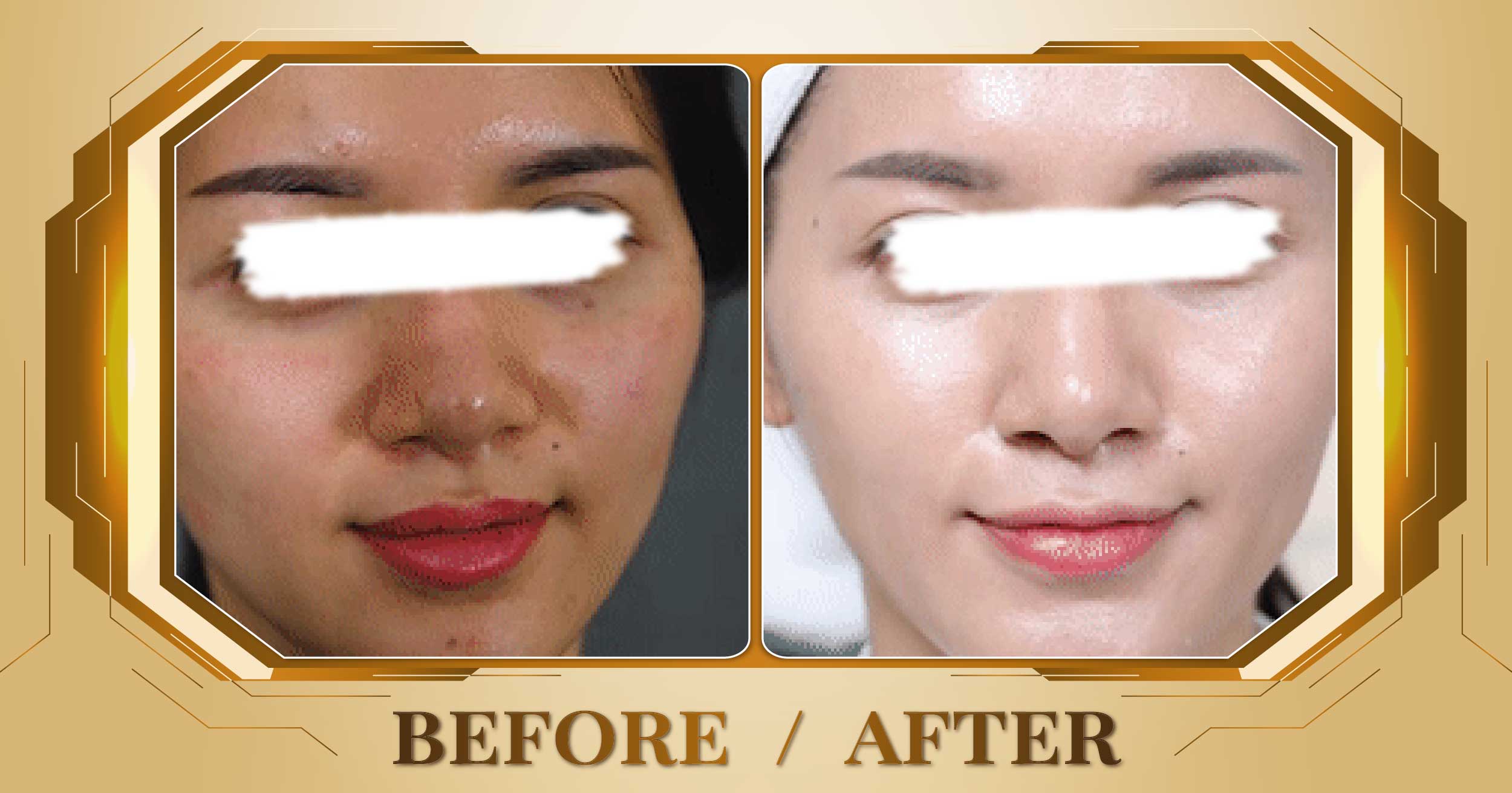Lấy nhân mụn chuẩn y khoa tại Thẩm Mỹ Viện Beryl 27 Lay nhan mun 11
