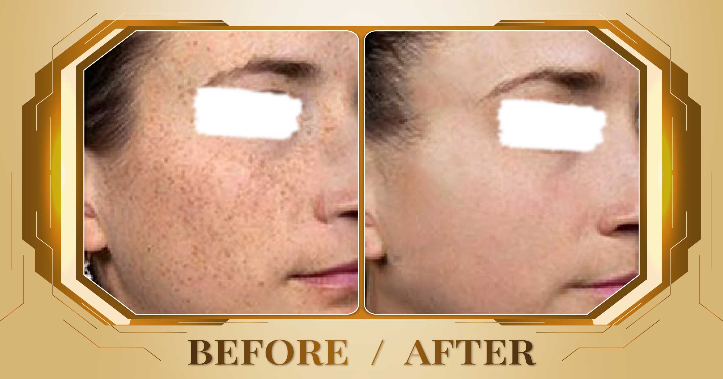 Trị nám hỗn hợp bằng laser Alpha Pro+ kết hợp Magic Skin 29 Tri nam hon hop 12