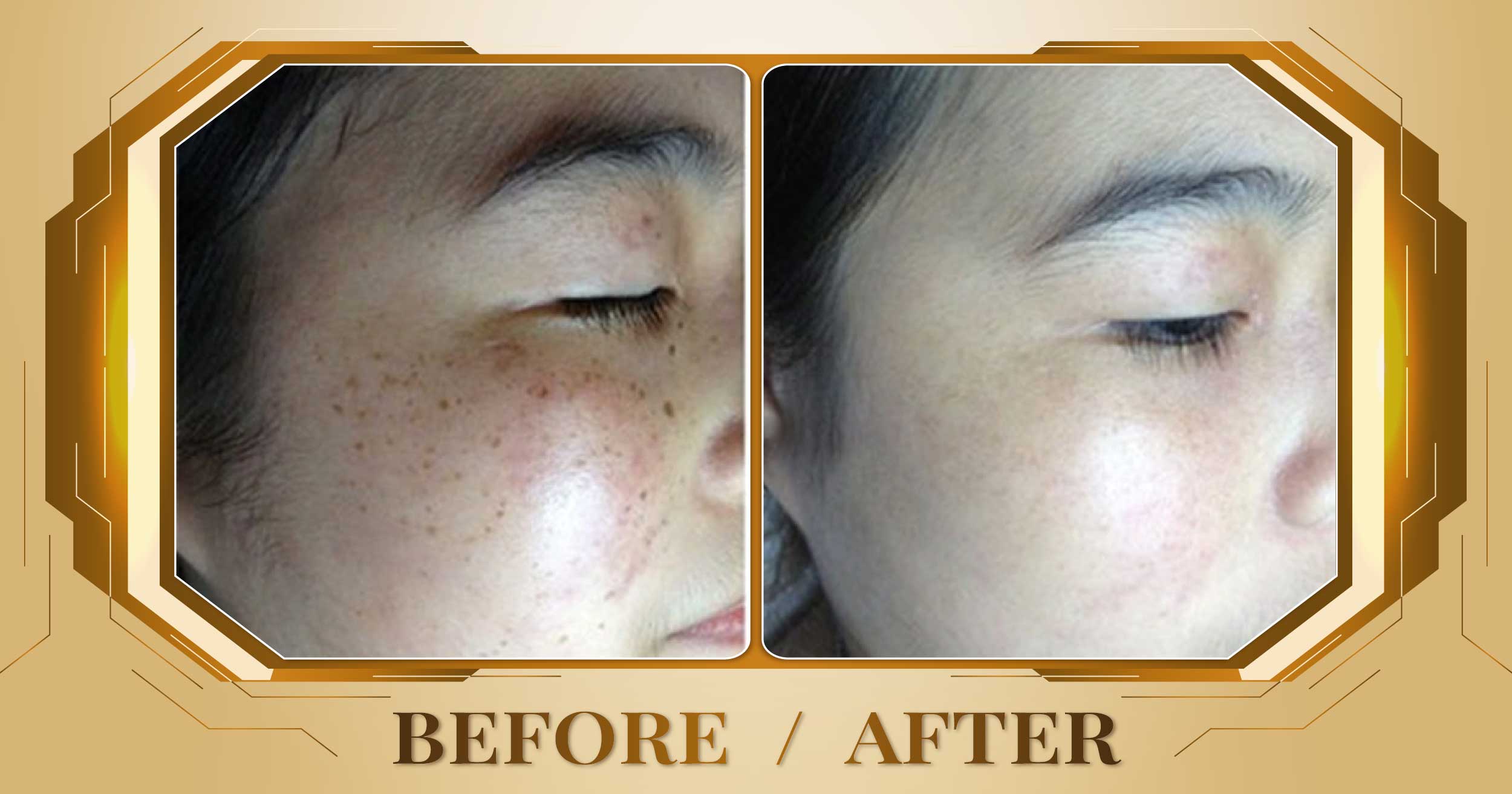Trị nám sau sinh bằng laser Alpha Pro+ kết hợp Magic Skin 20 Tri nam sau sinh 03