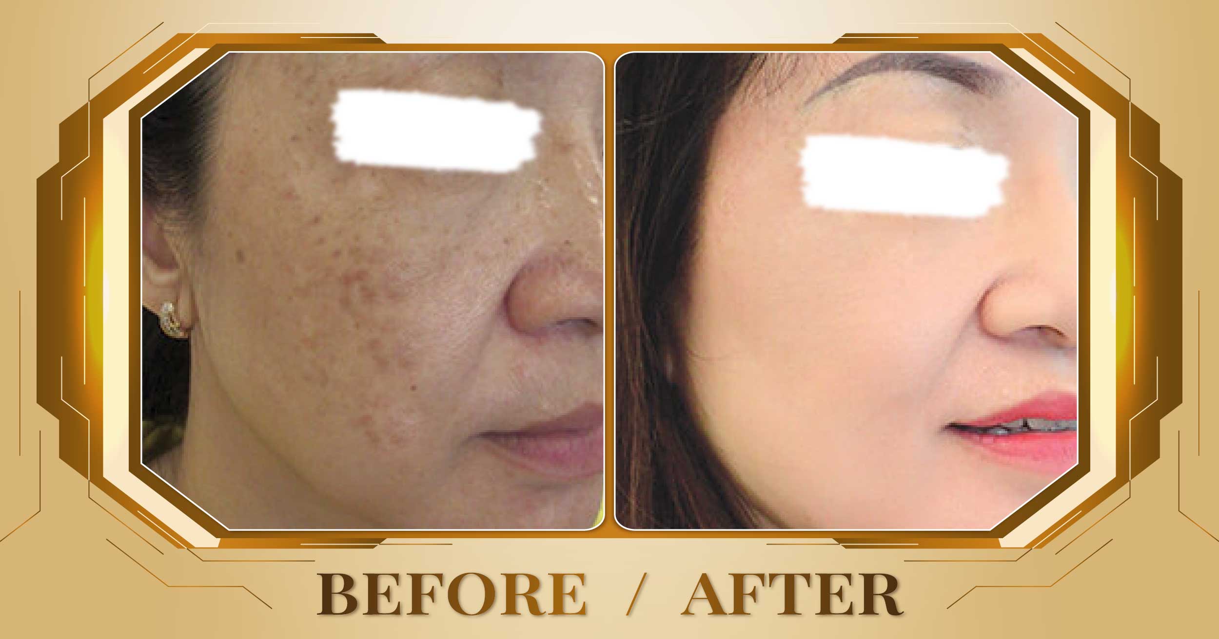 Trị nám sau sinh bằng laser Alpha Pro+ kết hợp Magic Skin 23 Tri nam sau sinh 06