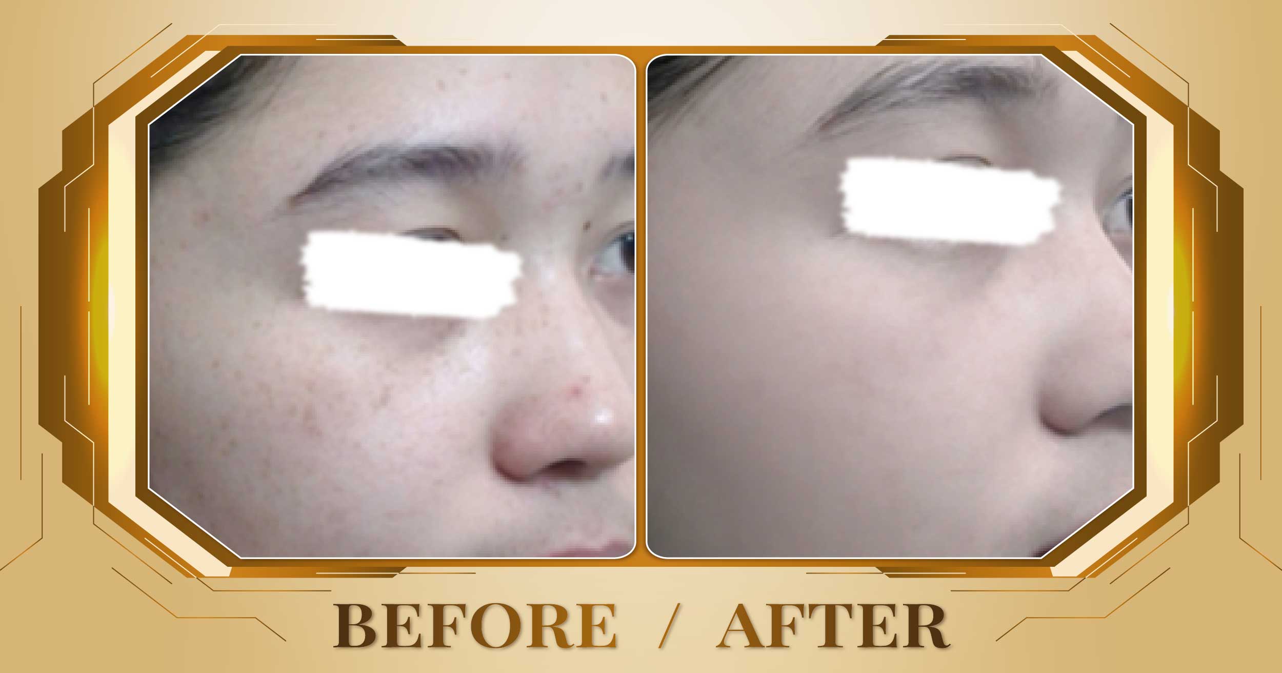 Trị nám sau sinh bằng laser Alpha Pro+ kết hợp Magic Skin 25 Tri nam sau sinh 08