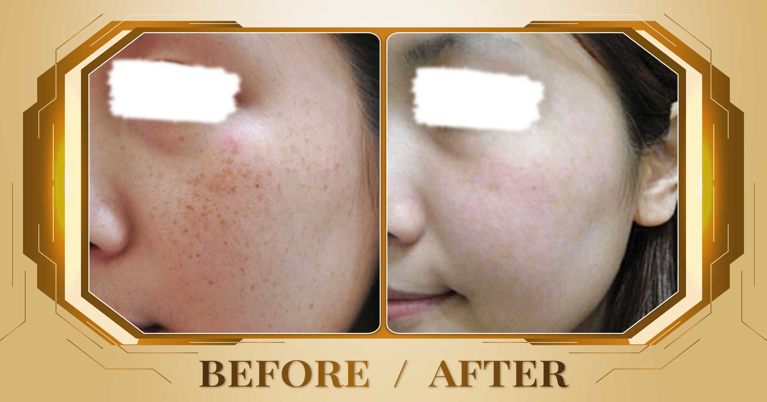 Trị nám sau sinh bằng laser Alpha Pro+ kết hợp Magic Skin 28 Tri nam sau sinh 11