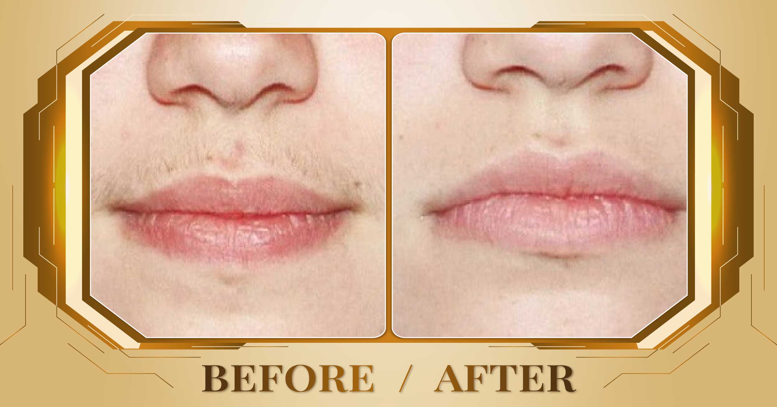 Triệt lông toàn thân bằng công nghệ SHR AFT IPL 21 Triet long toan than 05