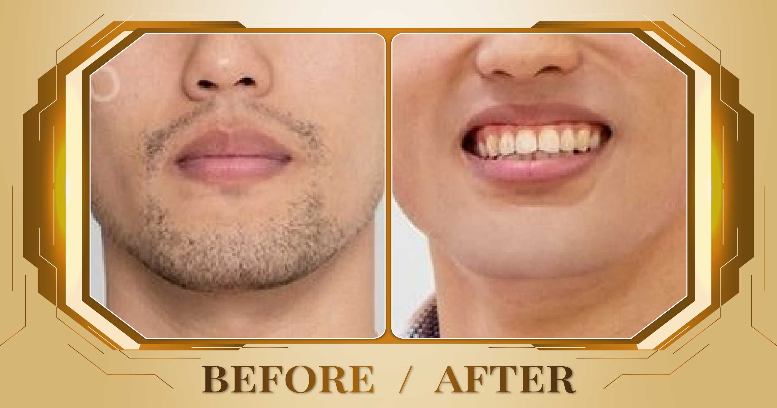 Triệt lông toàn thân bằng công nghệ SHR AFT IPL 24 Triet long toan than 08