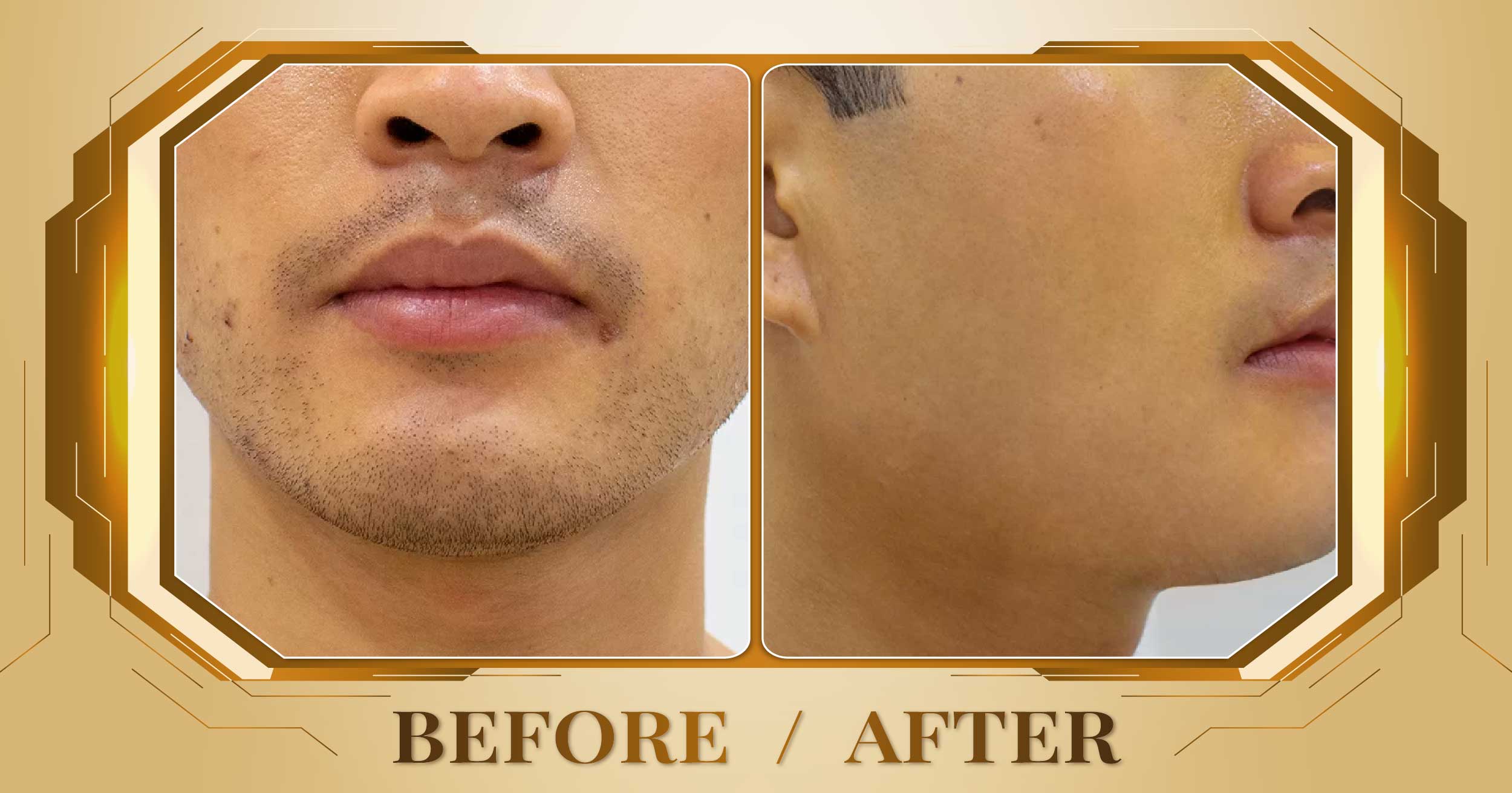 Triệt lông toàn thân bằng công nghệ SHR AFT IPL 25 Triet long toan than 09
