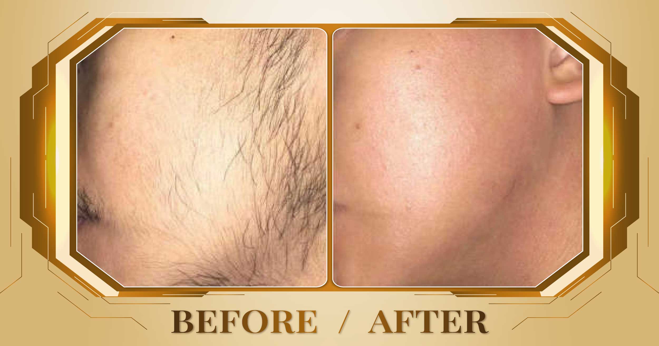 Triệt lông toàn thân bằng công nghệ SHR AFT IPL 26 Triet long toan than 10