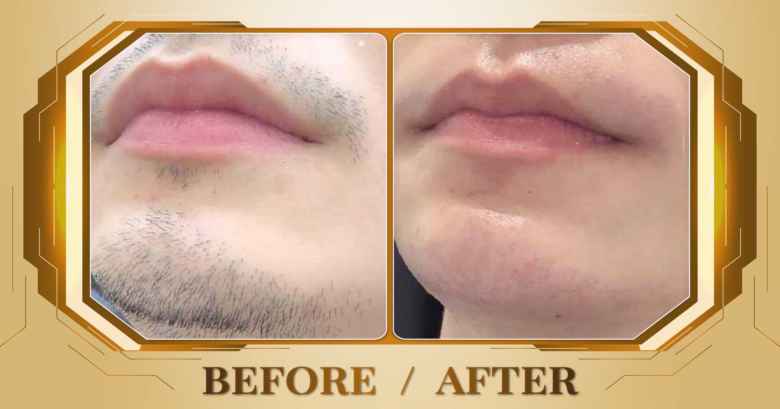 Triệt lông toàn thân bằng công nghệ SHR AFT IPL 27 Triet long toan than 11