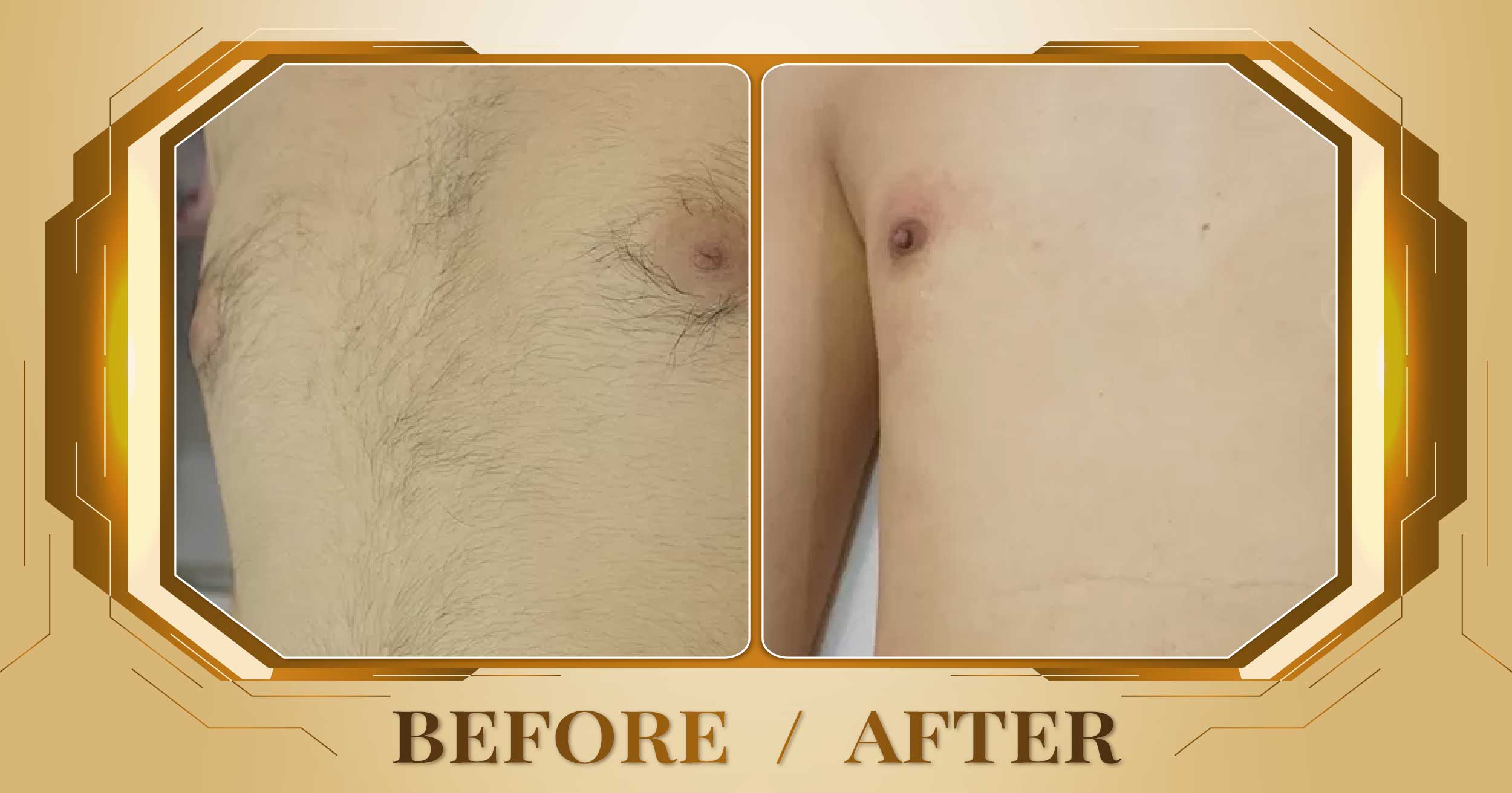 Triệt lông toàn thân bằng công nghệ SHR AFT IPL 28 Triet long toan than 12